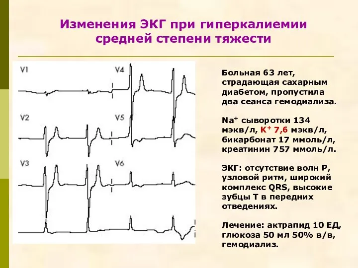 Изменения ЭКГ при гиперкалиемии средней степени тяжести Больная 63 лет, страдающая сахарным диабетом,