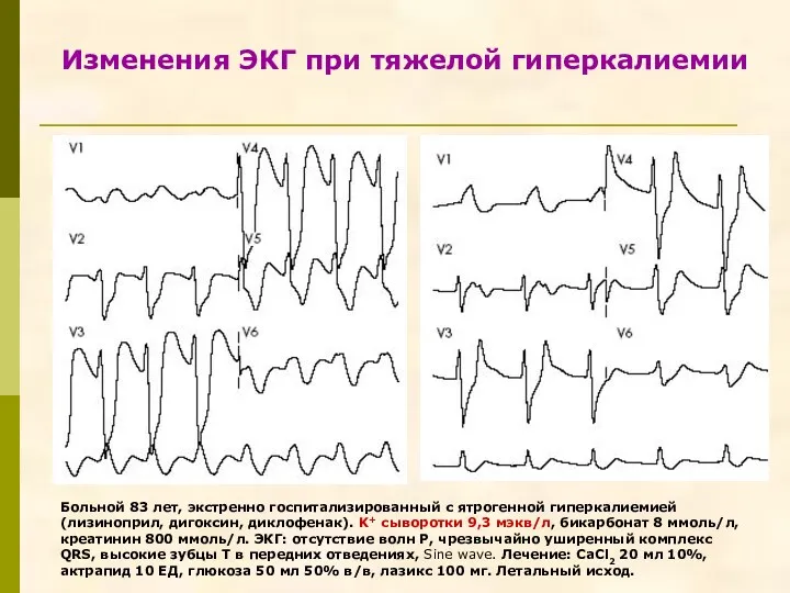 Изменения ЭКГ при тяжелой гиперкалиемии Больной 83 лет, экстренно госпитализированный с ятрогенной гиперкалиемией