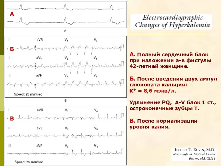 А. Полный сердечный блок при наложении а-в фистулы 42-летней женщине. Б. После введения