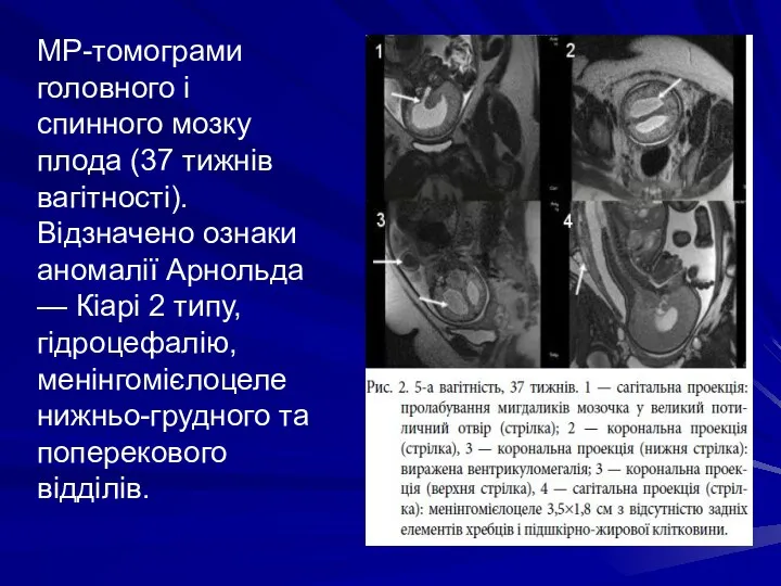 МР-томограми головного і спинного мозку плода (37 тижнів вагітності). Відзначено