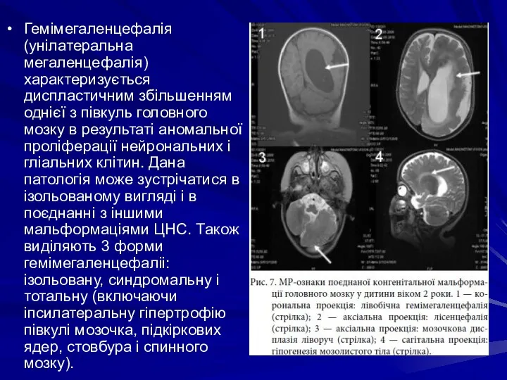 Гемімегаленцефалія (унілатеральна мегаленцефалія) характеризується диспластичним збільшенням однієї з півкуль головного