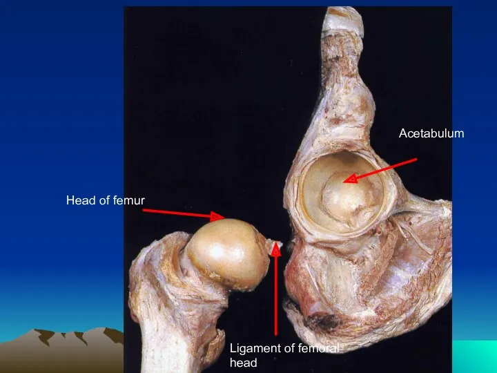 Acetabulum Head of femur Ligament of femoral head