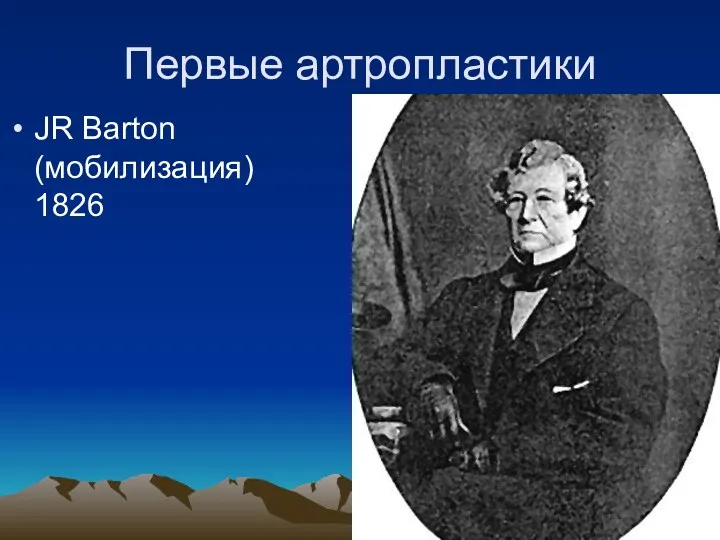 Первые артропластики JR Barton (мобилизация) 1826