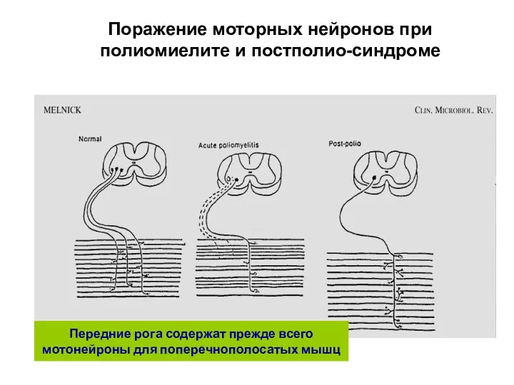 Поражение моторных нейронов при полиомиелите и постполио-синдроме Передние рога содержат прежде всего мотонейроны для поперечнополосатых мышц