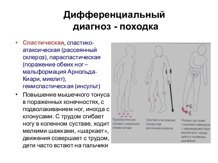 Дифференциальный диагноз - походка Спастическая, спастико-атаксическая (рассеянный склероз), параспастическая (поражение обеих ног –