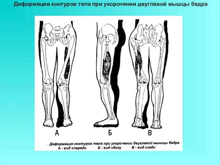 Деформация контуров тела при укорочении двуглавой мышцы бедра