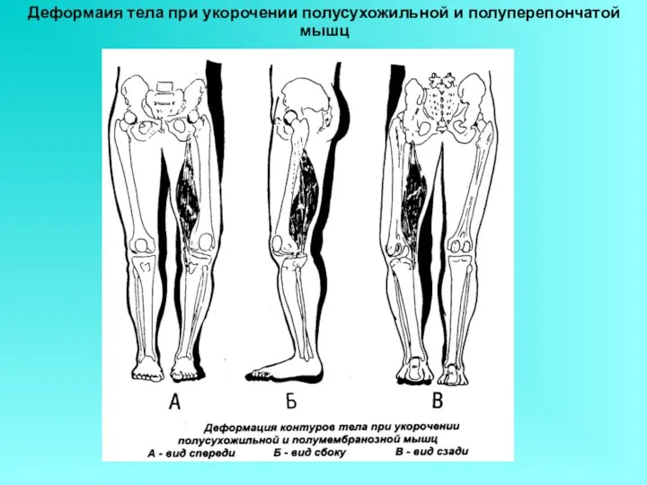 Деформаия тела при укорочении полусухожильной и полуперепончатой мышц