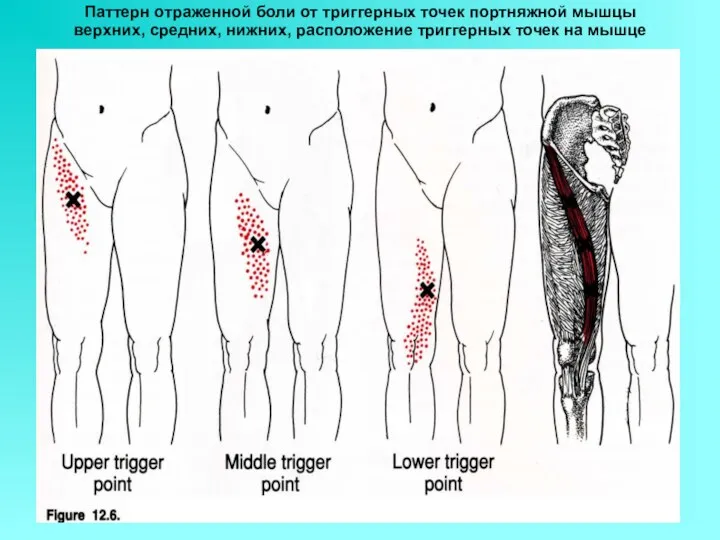 Паттерн отраженной боли от триггерных точек портняжной мышцы верхних, средних, нижних, расположение триггерных точек на мышце