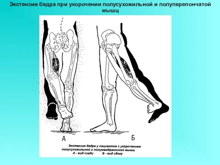 Экстензия бедра при укорочении полусухожильной и полуперепончатой мышц