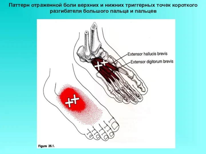 Паттерн отраженной боли верхних и нижних триггерных точек короткого разгибателя большого пальца и пальцев