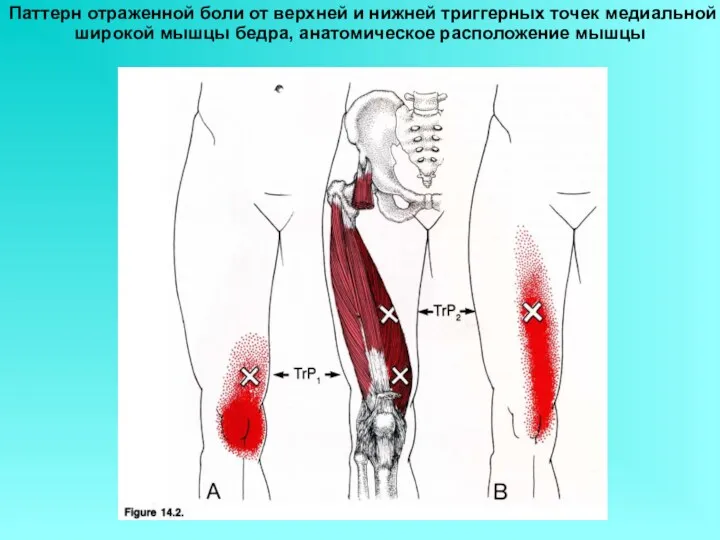 Паттерн отраженной боли от верхней и нижней триггерных точек медиальной широкой мышцы бедра, анатомическое расположение мышцы