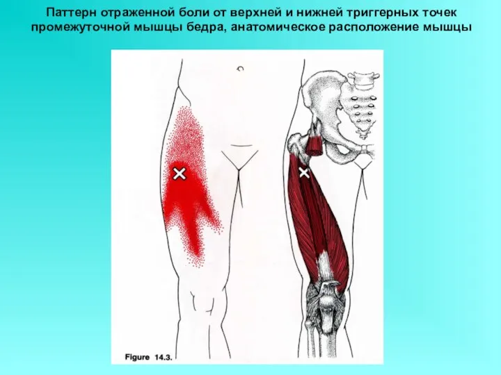 Паттерн отраженной боли от верхней и нижней триггерных точек промежуточной мышцы бедра, анатомическое расположение мышцы