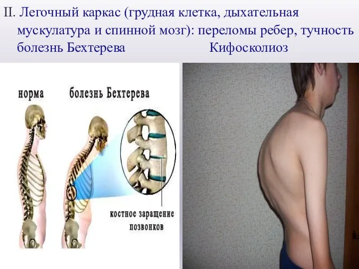 II. Легочный каркас (грудная клетка, дыхательная мускулатура и спинной мозг): переломы ребер, тучность болезнь Бехтерева Кифосколиоз
