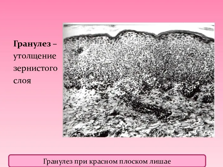 Гранулез – утолщение зернистого слоя Гранулез при красном плоском лишае