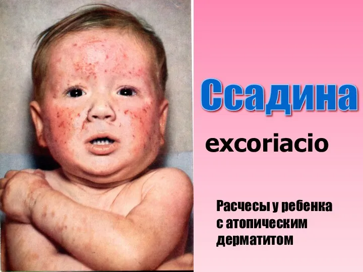 Ссадина Расчесы у ребенка с атопическим дерматитом excoriacio