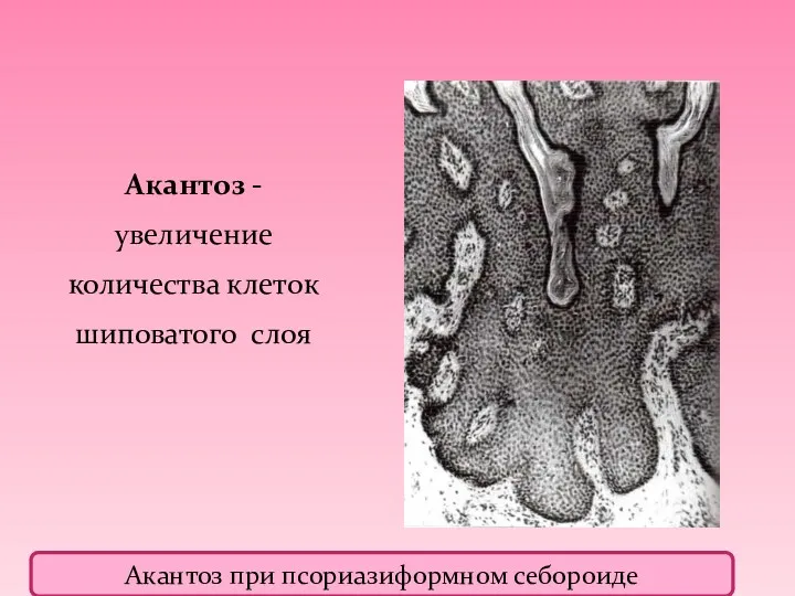 Акантоз - увеличение количества клеток шиповатого слоя Акантоз при псориазиформном себороиде