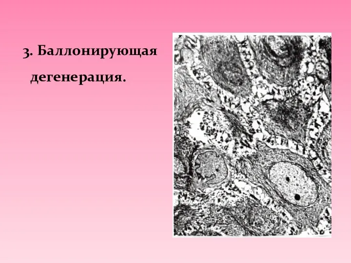 3. Баллонирующая дегенерация.