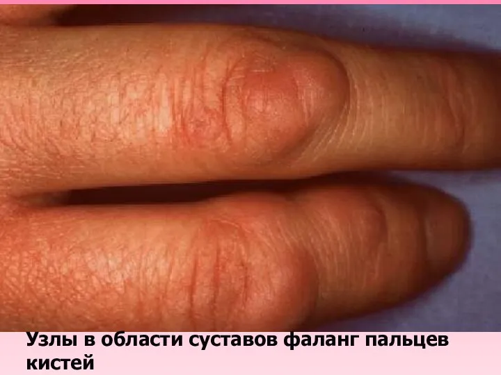 Узлы в области суставов фаланг пальцев кистей