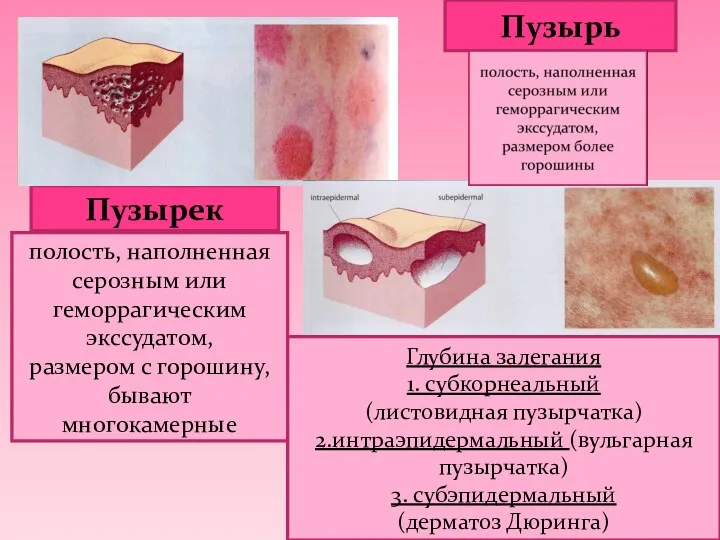 Пузырек Пузырь полость, наполненная серозным или геморрагическим экссудатом, размером с горошину, бывают многокамерные