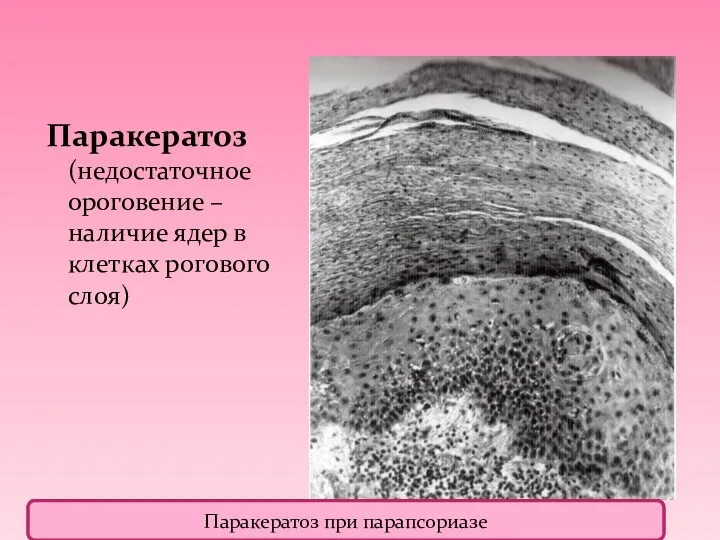 Паракератоз (недостаточное ороговение – наличие ядер в клетках рогового слоя) Паракератоз при парапсориазе Паракератоз при парапсориазе