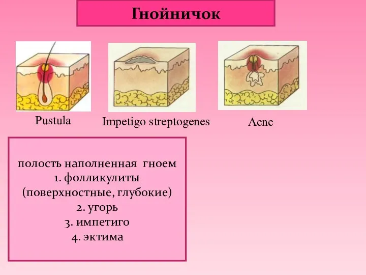 Гнойничок полость наполненная гноем 1. фолликулиты (поверхностные, глубокие) 2. угорь 3. импетиго 4.