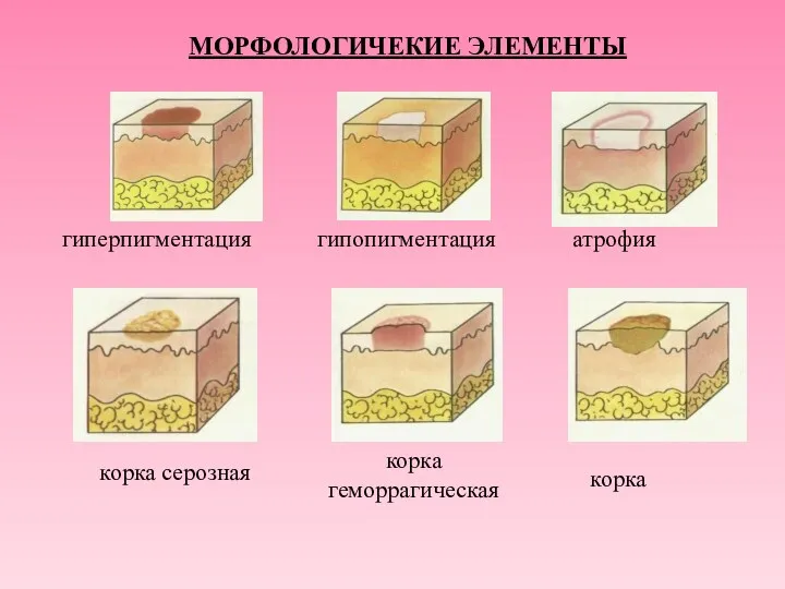 МОРФОЛОГИЧЕКИЕ ЭЛЕМЕНТЫ гиперпигментация гипопигментация атрофия корка серозная корка геморрагическая корка