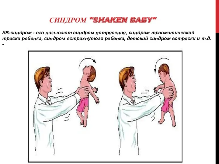 СИНДРОМ "SHAKEN BABY" SВ-синдром - его называют синдром потрясения, синдром травматической тряски ребенка,