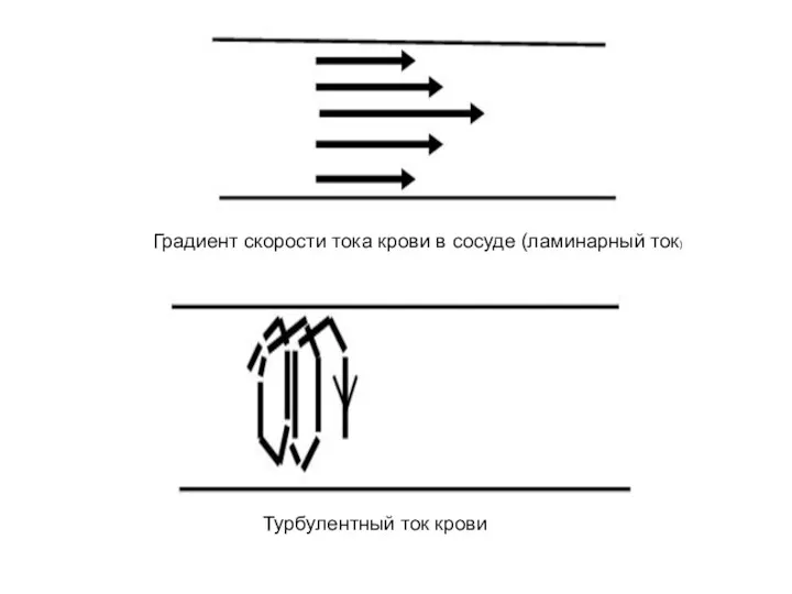 Градиент скорости тока крови в сосуде (ламинарный ток) Турбулентный ток крови