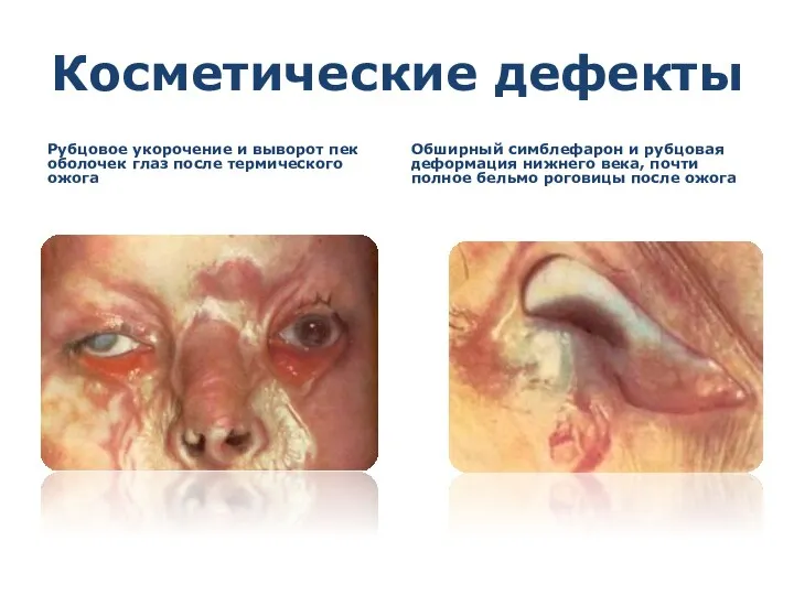 Косметические дефекты Рубцовое укорочение и выворот пек оболочек глаз после термического ожога Обширный