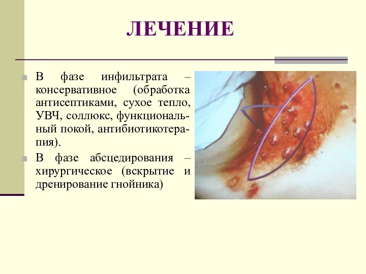 ЛЕЧЕНИЕ В фазе инфильтрата – консервативное (обработка антисептиками, сухое тепло,