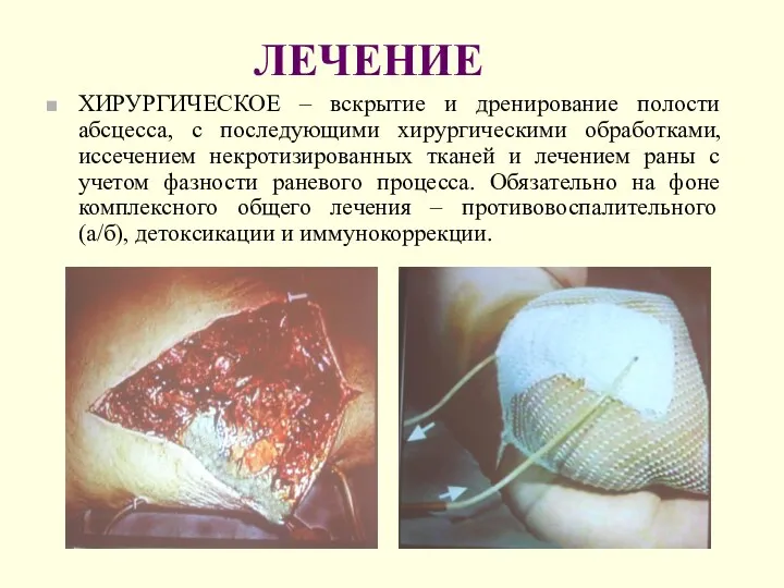 ЛЕЧЕНИЕ ХИРУРГИЧЕСКОЕ – вскрытие и дренирование полости абсцесса, с последующими