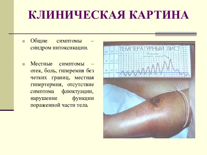 КЛИНИЧЕСКАЯ КАРТИНА Общие симптомы – синдром интоксикации. Местные симптомы –