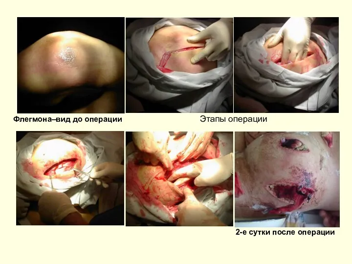 Флегмона–вид до операции Этапы операции 2-е сутки после операции