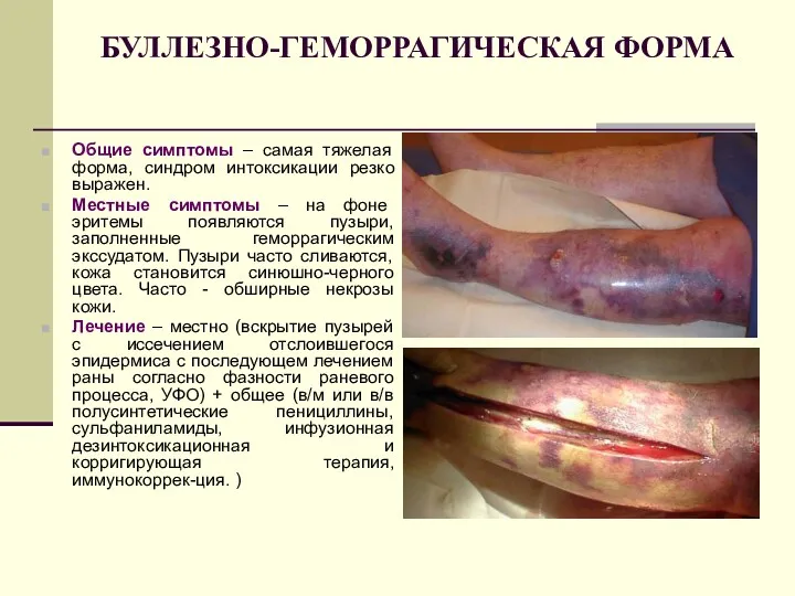 БУЛЛЕЗНО-ГЕМОРРАГИЧЕСКАЯ ФОРМА Общие симптомы – самая тяжелая форма, синдром интоксикации