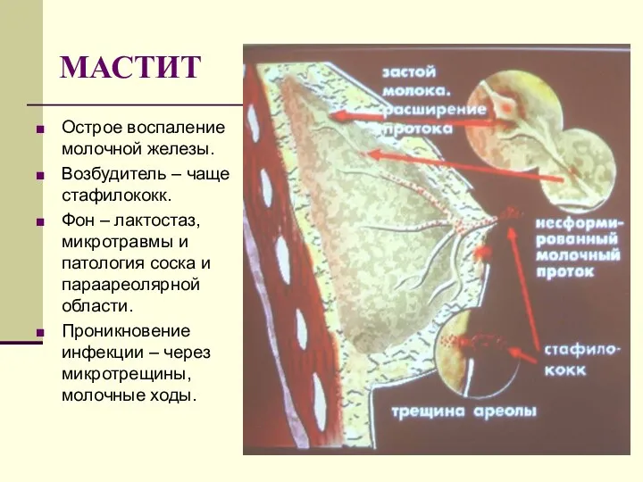 МАСТИТ Острое воспаление молочной железы. Возбудитель – чаще стафилококк. Фон