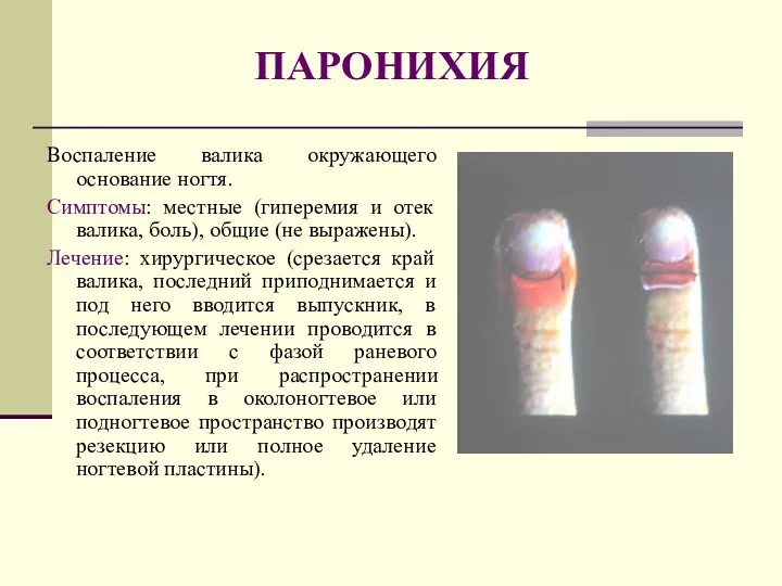 ПАРОНИХИЯ Воспаление валика окружающего основание ногтя. Симптомы: местные (гиперемия и