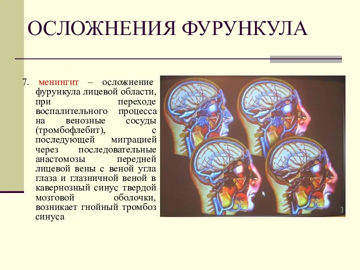 ОСЛОЖНЕНИЯ ФУРУНКУЛА 7. менингит – осложнение фурункула лицевой области, при