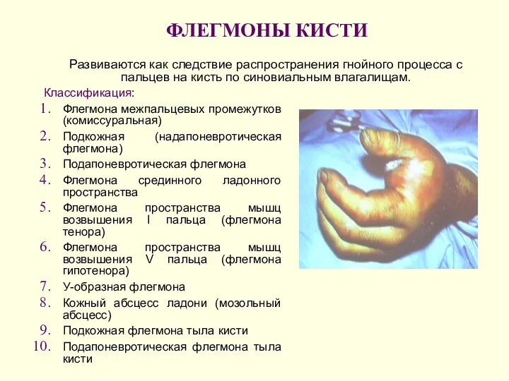 ФЛЕГМОНЫ КИСТИ Классификация: Флегмона межпальцевых промежутков (комиссуральная) Подкожная (надапоневротическая флегмона)