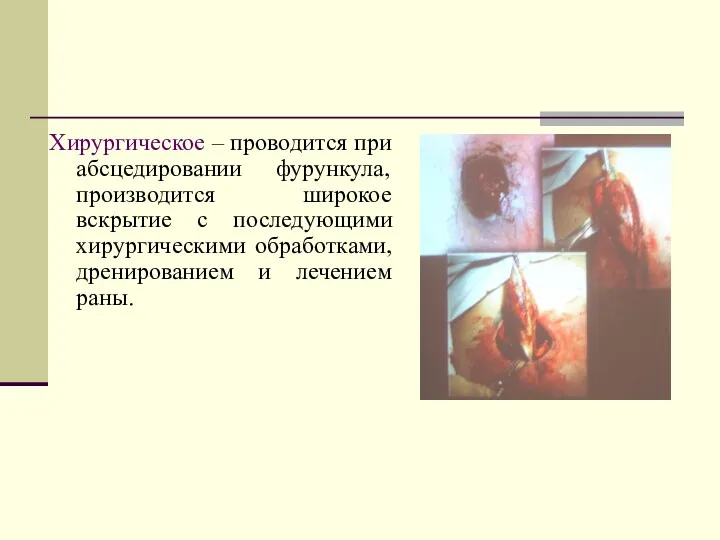 Хирургическое – проводится при абсцедировании фурункула, производится широкое вскрытие с