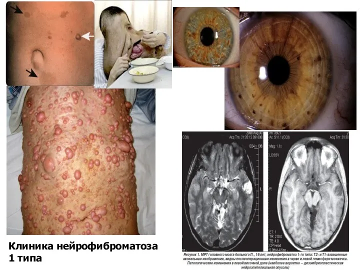 Клиника нейрофиброматоза 1 типа