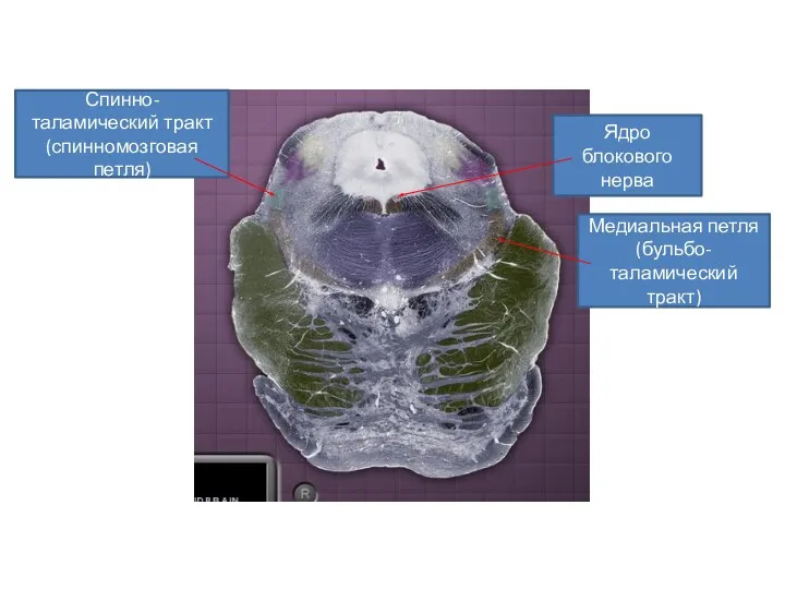 Ядро блокового нерва Спинно-таламический тракт(спинномозговая петля) Медиальная петля (бульбо-таламический тракт)