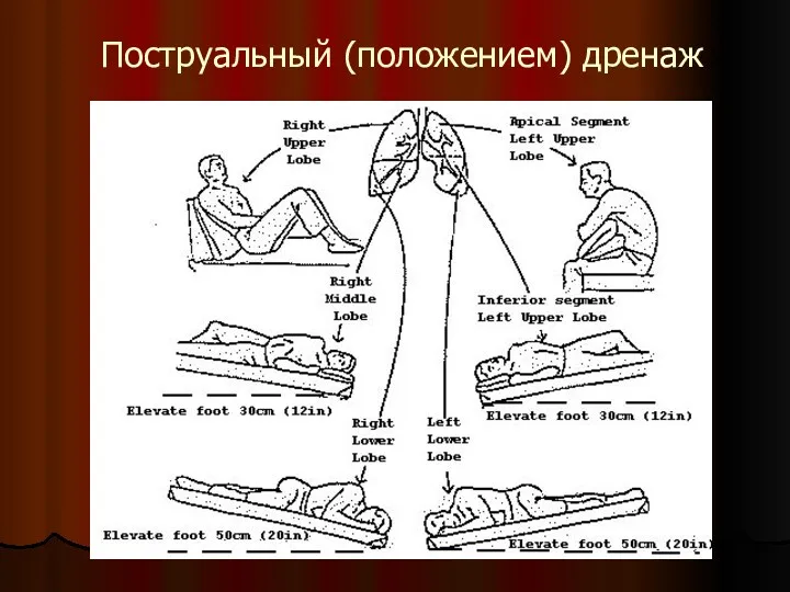 Поструальный (положением) дренаж