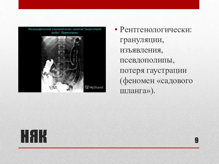 НЯК Рентгенологически: грануляции, изъявления, псевдополипы, потеря гаустрации (феномен «садового шланга»).