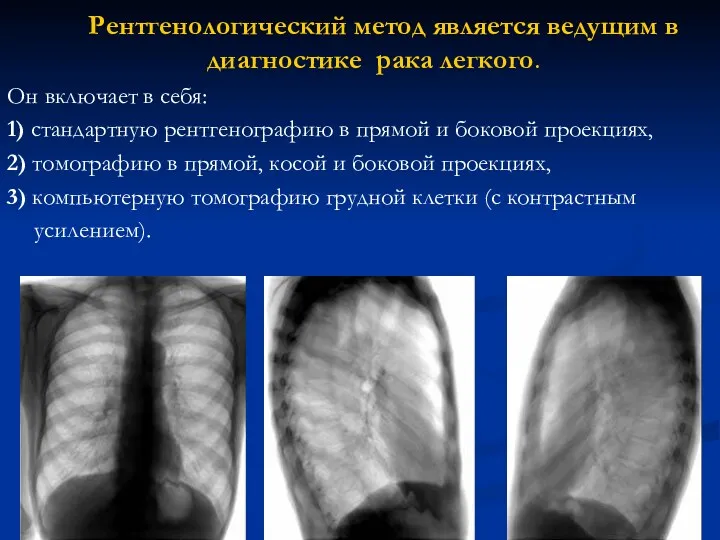 Рентгенологический метод является ведущим в диагностике рака легкого. Он включает