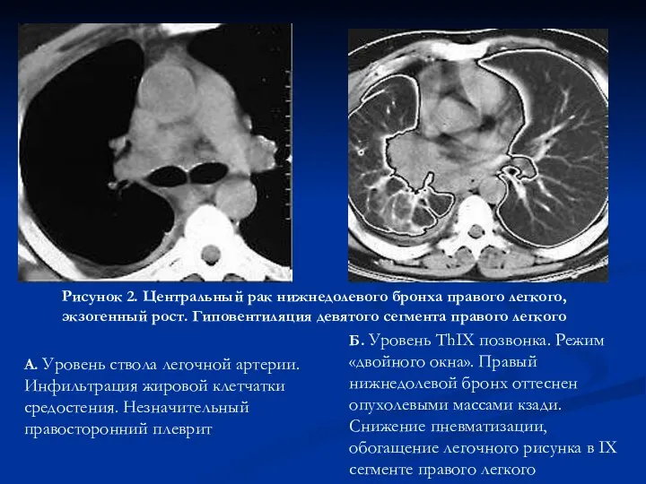 Рисунок 2. Центральный рак нижнедолевого бронха правого легкого, экзогенный рост.