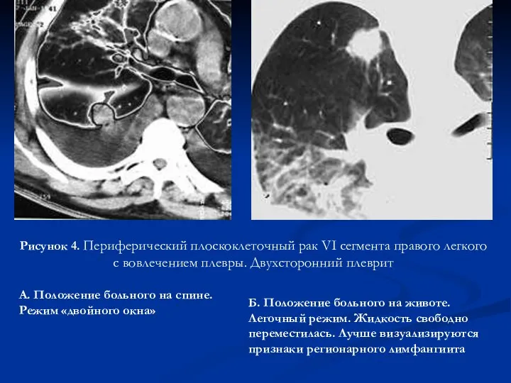 Рисунок 4. Периферический плоскоклеточный рак VI сегмента правого легкого с