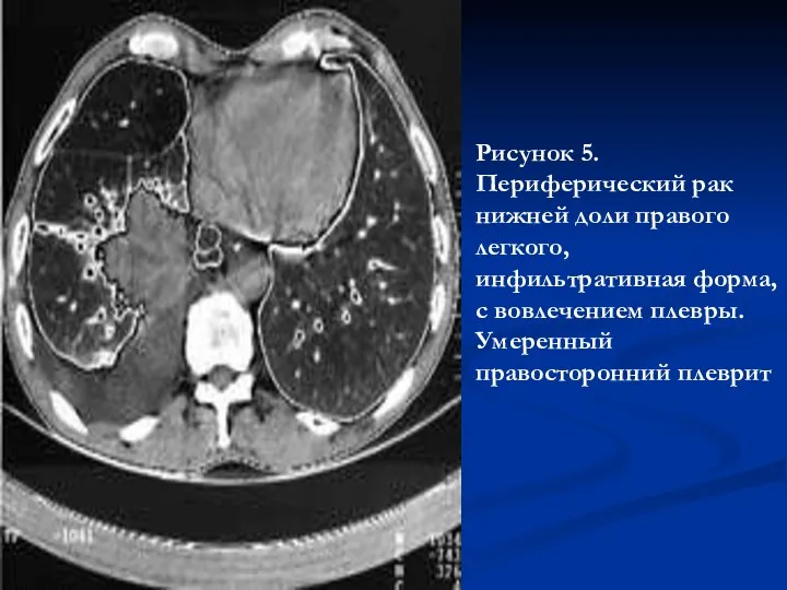 Рисунок 5. Периферический рак нижней доли правого легкого, инфильтративная форма, с вовлечением плевры. Умеренный правосторонний плеврит