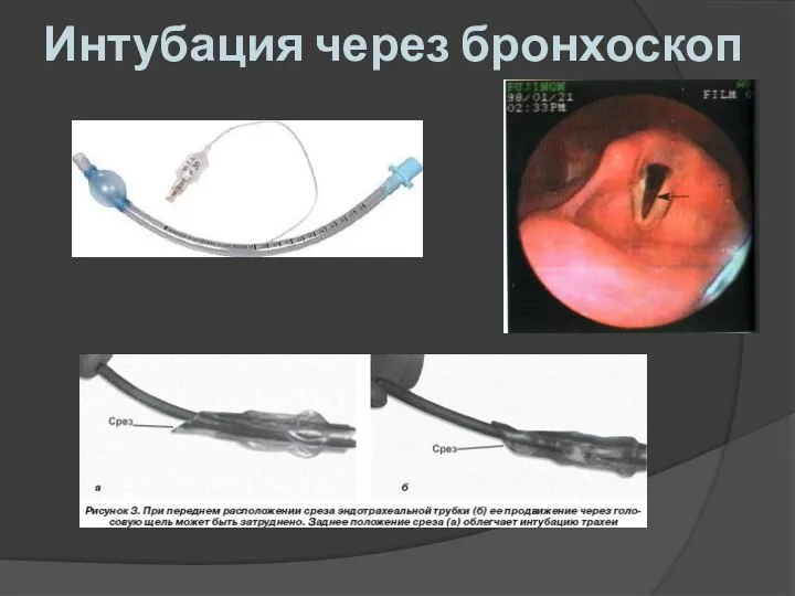 Интубация через бронхоскоп