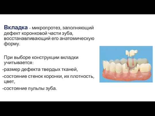 Вкладка - микропротез, заполняющий дефект коронковой части зуба, восстанавливающий его анатомическую форму. При