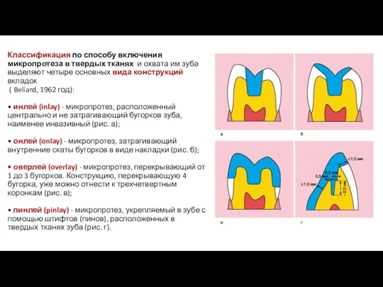 Классификация по способу включения микропротеза в твердых тканях и охвата им зуба выделяют